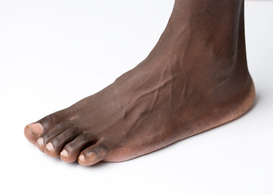 foot disease 2