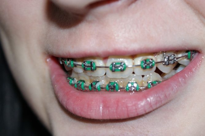 dental braces